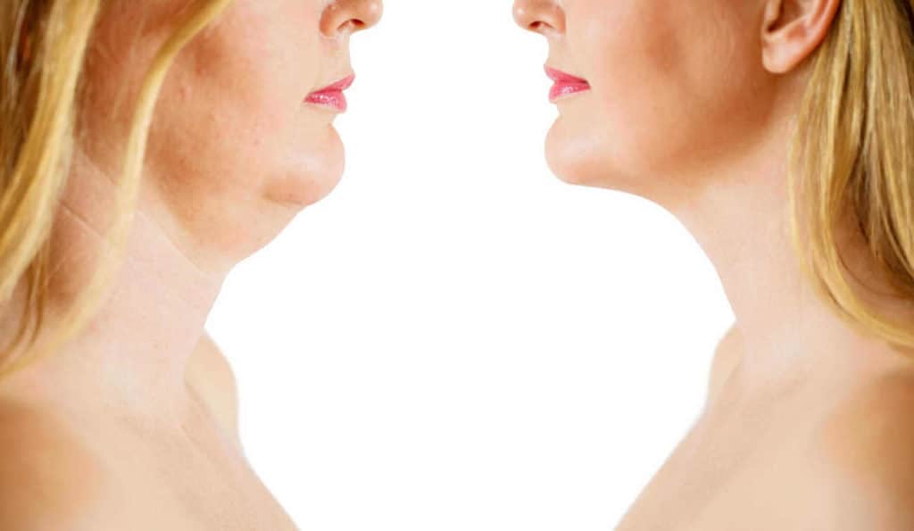 Double Chin treatment Daventry before and after results