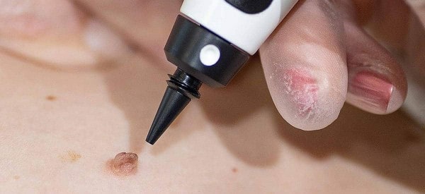 After Skin Tag Removal Daventry