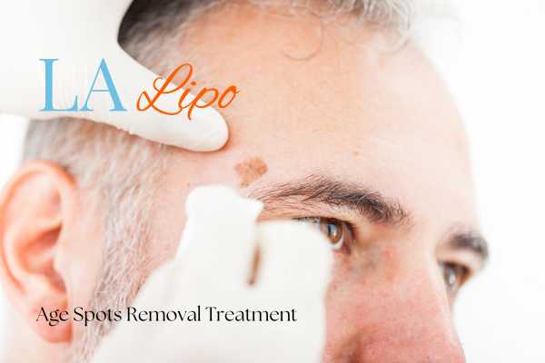 What Are the Most Effective Treatments for Age Spots Daventry?
