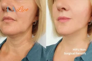 hi-fu for wrinkles Daventry before and after results