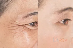 Before and after results of woman - HI-fu wrinkles reduction treatment Daventry