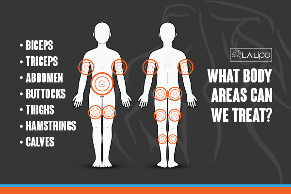 Graphic to show areas you can have LA-EMS Body Sculpting Daventry treatment.
