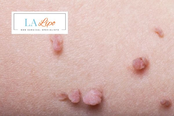 Does cryopen skin tag removal Daventry hurt? Find out now call our team today!