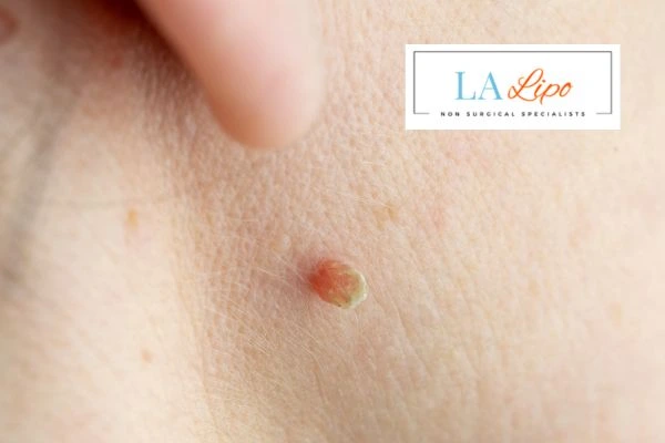Book skin tag removal Daventry today speak to our team now!