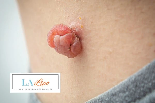 Interested in skin tag removal Daventry? Concerned about the pain? Find out more today!