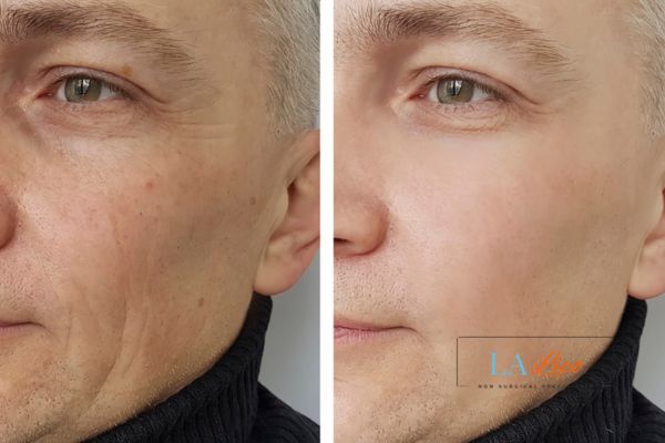 See the amazing results of Morpheus8 Treatment Daventry!