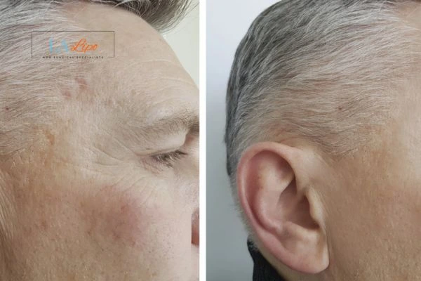 Mens Before & After Morpheus 8 Results Daventry