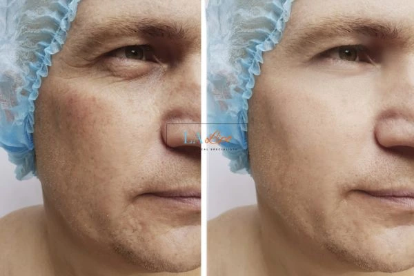 Before and after Morpheus 8 Results Daventry