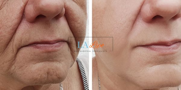 Older lady deeper wrinkle reduction - LA LIPO Morpheus 8 Results Daventry