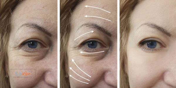 Amazing eye lift Morpheus 8 results Daventry