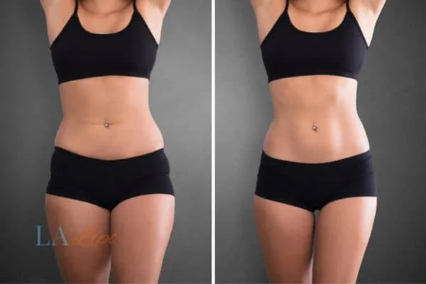 before and after results of non-surgical treatment to help a woman's body image and mental health Daventry