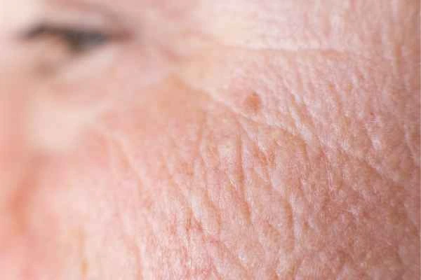 close up picture of a woman's face showing an age spot Daventry