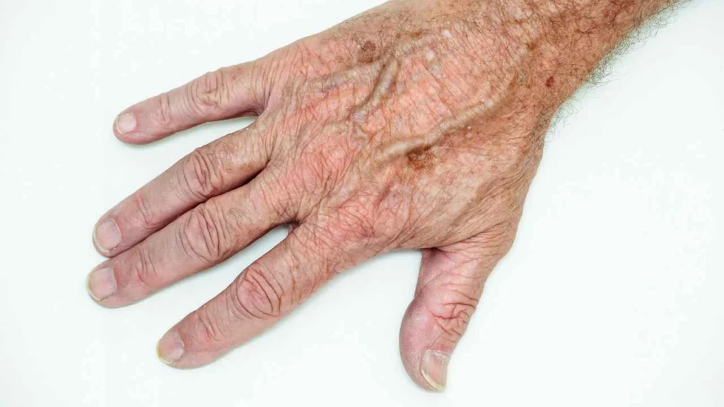 Male hand showing age spot Daventry